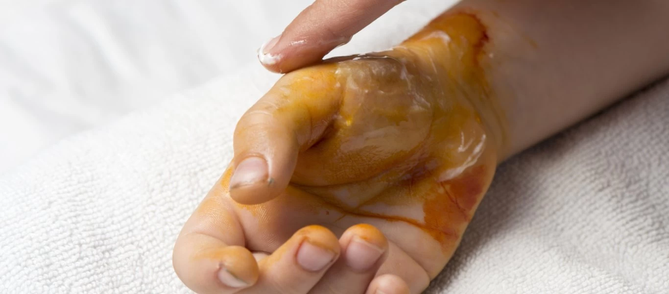 Θερμικό, χημικό, ή έγκαυμα στην κουζίνα; - Τι να κάνετε στην κάθε περίπτωση